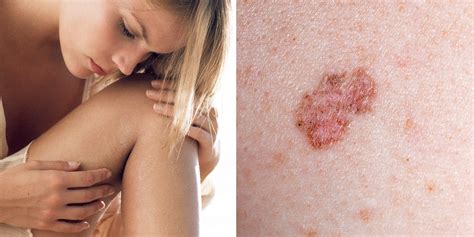 10 Signs Of Skin Cancer You Shouldnt Ignore Self