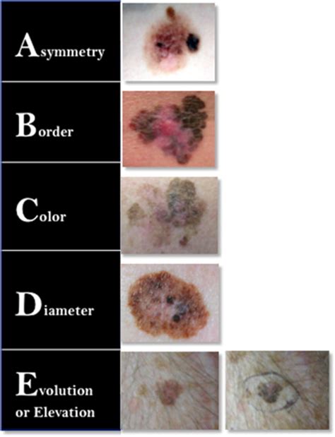 Workup And Staging Of Malignant Melanoma Surgical Clinics