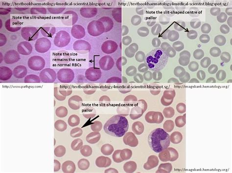 Haematology In A Nutshell Stomatocytes