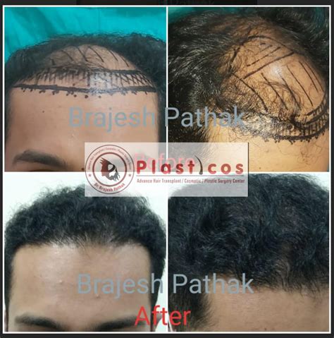 Gallery Dr Brajesh Pathak Plasticos Best Hair Treatment