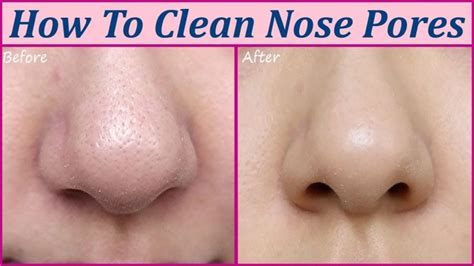 Find Out How To Unclog Clear And Shrink Pores On The Nostril