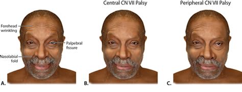 As shown in the diagram, the forehead receives motor innervation from both hemispheres of the cerebral cortex. Bell's Palsy Symptoms - Bell S Palsy Symptoms Diagnosis ...