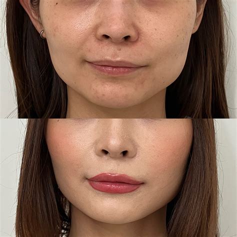 30代女性 ヒアルロン酸注入 ほうれい線・頬骨 の症例写真 No 3105｜美容整形の症例｜キリクリニック