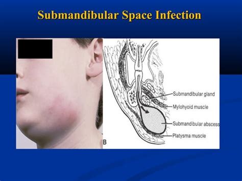 Fascial Space And Infections