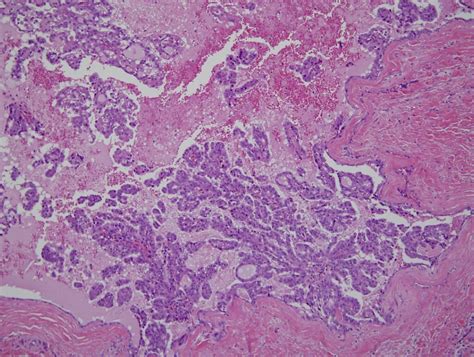 5 Salivary Glands Epithelial Myoepithelial Tumors Ma Flickr