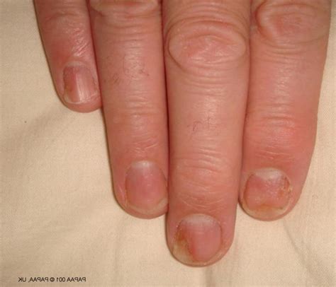 Patel added the main symptom of this type of melanoma is a pigmented vertical streak on the nail. Nail bed melanoma photos