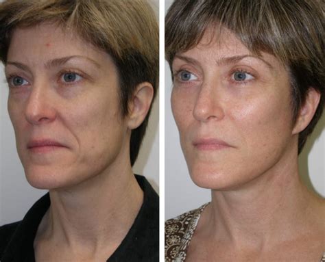 Cheek Implants Richmond Va Facial Fillers Midface Implants