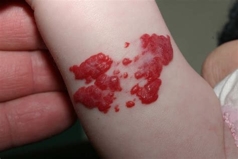 Birthmark Causes Types Of Birthmarks And How To Get Rid Of Birthmarks