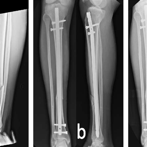 Tibial Shaft Fracture Treated With Mono Planar Distal Locking