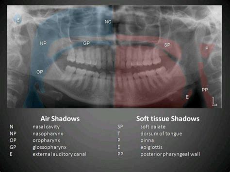 Radiographic Interpretation