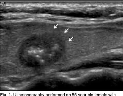 Papillary Thyroid Cancer Ultrasound