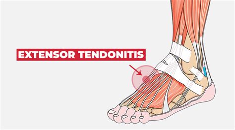 Tendonitis On Top Of Foot Neuritis And Neuromas Footeducation The