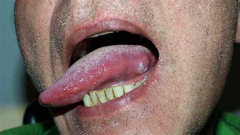 Early Tongue Cancer Pictures Picturemeta