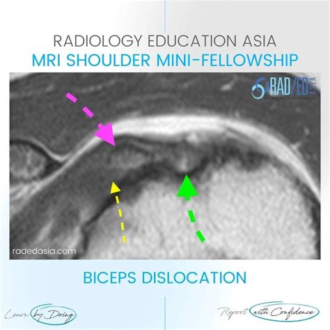 Biceps Dislocation Radiology Mri Shoulder Radedasia