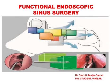 Functional Endoscopic Sinus Surgery Ppt