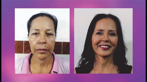 Lifting Facial 👸 Rejuvenecimiento Facial Antes Y Despues 💕cirugÍa