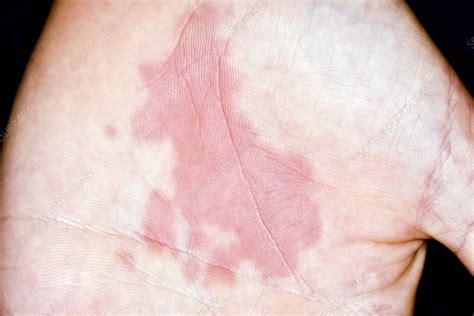 Urticaria Stock Image C0269176 Science Photo Library