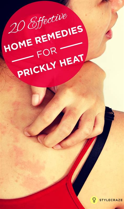 27 Effective Home Remedies For Prickly Heat Heat Rash Treatment Prickly Heat Heat Rash