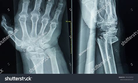 Radius Fracture Images Stock Photos And Vectors Shutterstock