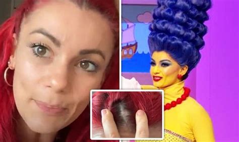 Dianne Buswell Shares Video Of Bald Patch Caused By Marge Simpson