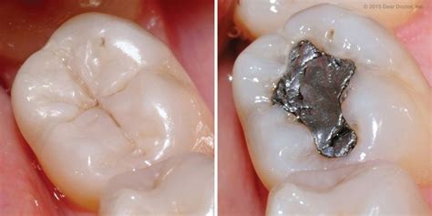 It depends on the type of filling you need. Tooth-Colored Fillings vs. Metal: Which is Better ...