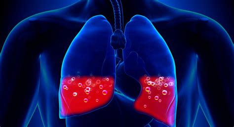 Edema pulmonar qué es causas y tipos de edema pulmonar