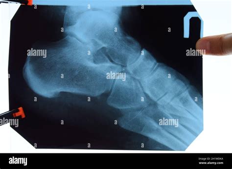 Radiografía De Huesos De Los Pies Y El Talón Imagen De Rayos X De Los
