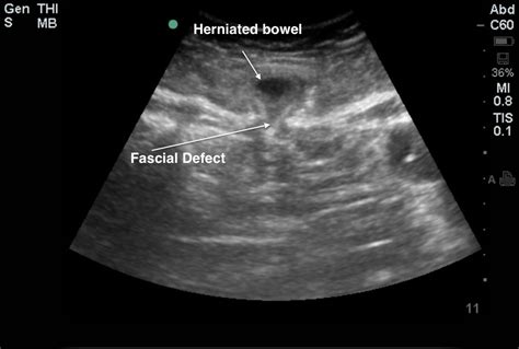 Abdominal Hernia With Images Abdominal Hernia Abdominal Ultrasound My