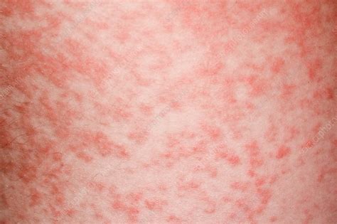 Amoxicillin Rash In Glandular Fever Stock Image C0345320 Science