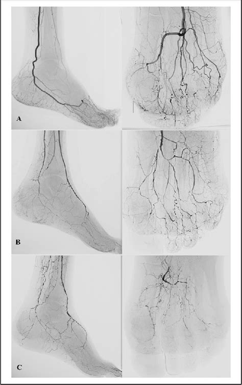 Figure 1 From A Novel Scoring System For Small Artery Disease And