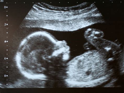 Prenatal Ultrasound Scans Babycenter Canada