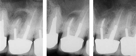 40 Endodontic Surgery Pocket Dentistry