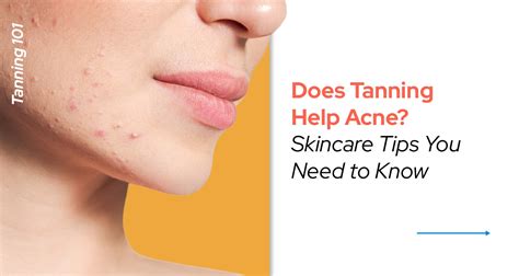 Does Tanning Help Acne Skincare Tips You Need To Know