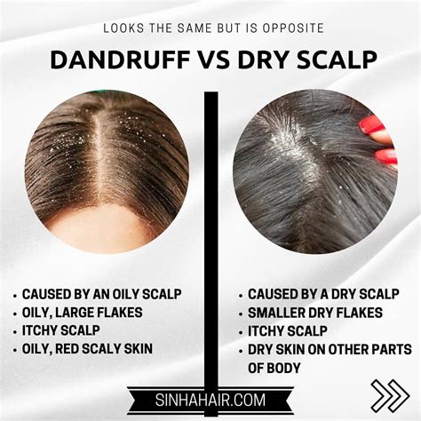 Dry Scalp Flakes