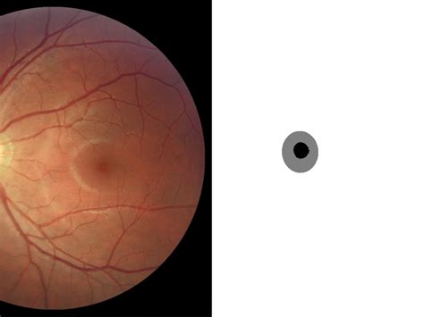Enhanced Optic Disk And Cup Segmentation With Glaucoma Screening From