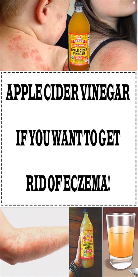 Apple Cider Vinegar If You Want To Get Rid Of Eczema Natural Eczema