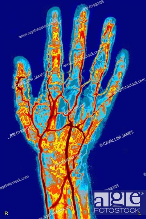 Hand Arteriography Vascular System Of The Hand Angiogram Of The Left