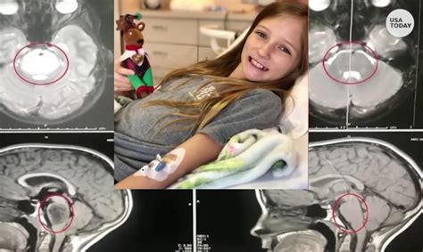From No Cure To No Trace—Girl's Inoperable Brain Tumor ...