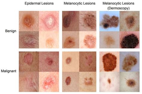 Stage Early Stage Melanoma Skin Cancer CancerWalls