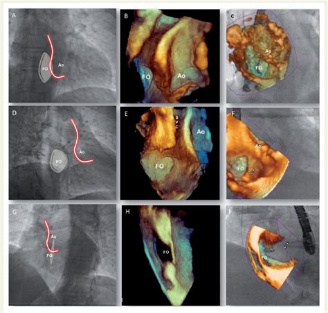 Figure 1 From Echocardiographic Fluoroscopic Fusion Imaging For