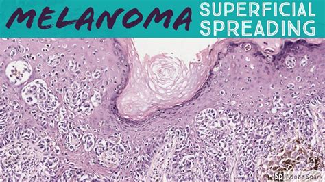 Superficial Spreading Melanoma 5 Minute Pathology Pearls Youtube