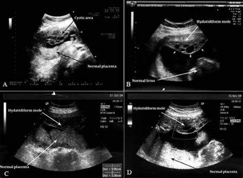 Dizygotic Twin Pregnancy With A Complete Hydatidiform Mole And A