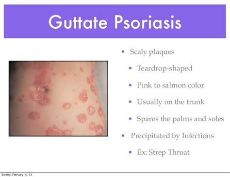 Psoriasis Clinical