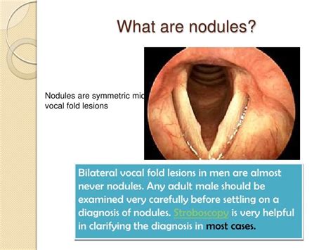 Vocal Nodules Symptoms Treatment More Cleveland Clinic