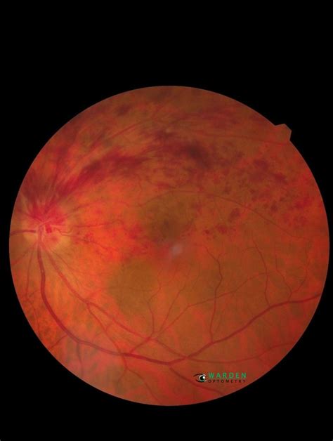 Whats An Ocular Stroke In 2021 Ocular Eye Health Vision Loss