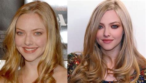 Amanda Seyfried Before And After Plastic Surgery Celebrity Plastic