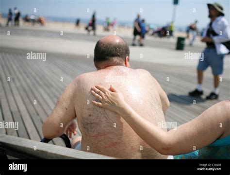 Erythema Solar Hi Res Stock Photography And Images Alamy