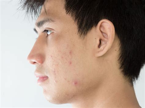 Best Acne And Blemish Treatments Getting Rid Of Spots
