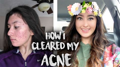 How I Cleared My Acne For Good Youtube
