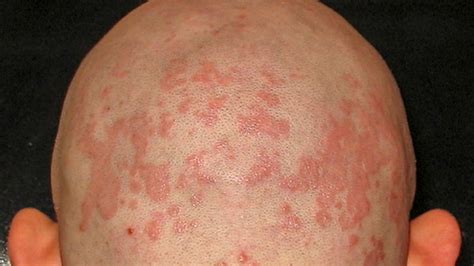 hiv symptoms rash